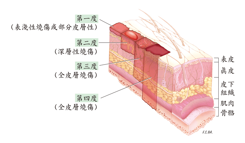 燒傷和其它病癥一樣，有輕微和嚴重之分，深度和面積是其程度判斷的依據